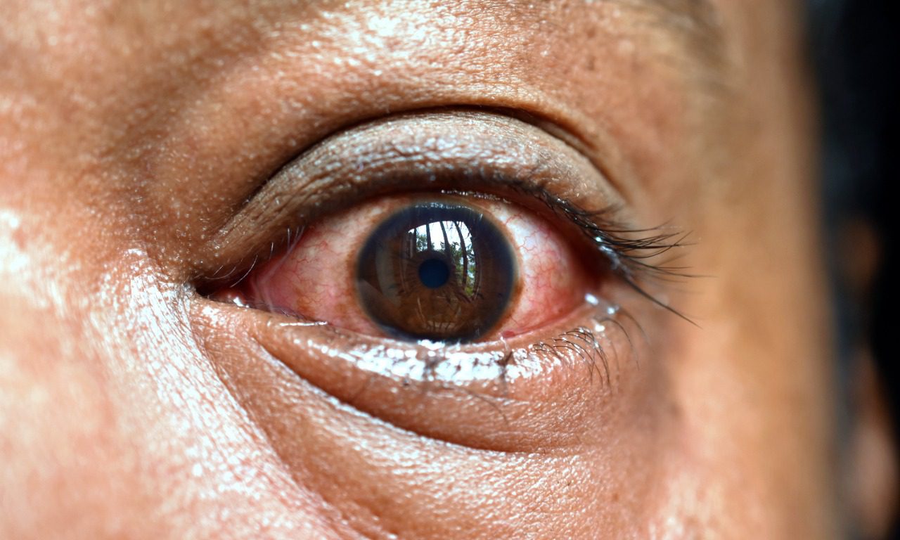 اعراض الفطر الاسود في العين